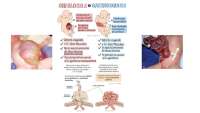 Onfalocele y Gastrosquisis