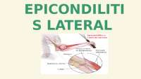 Epicondilitis lateral | Diapositivas de Diagnóstico | Docsity