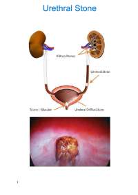 Urethral Stone: Incidence, Predisposing Factors, Pathology, Complications, and Treatment