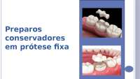 Protese fixa -Preparados conservadores em prótese fixa