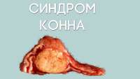 Синдром Кона презентація