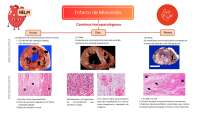 Infarto de miocardio- características macro y microscópicas