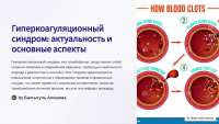 Гиперкоагуляционный синдром