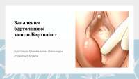 Запалення Бартолінової залози