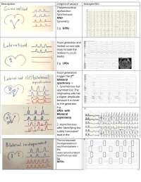 R.EEG.T - Secondary lateralized synchrony