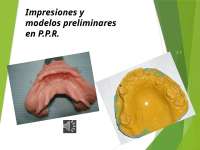 protesis parcial removible