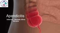 Apendicitis: Anatomía, Etiología, Fisiopatología, Diagnóstico y Tratamiento