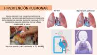 Hipertension pulmonar en recien nacido