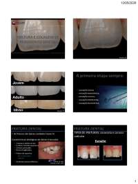 trauma e colagem de fragmento dental