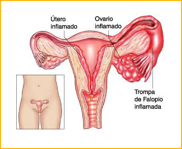 Enfermedad pélvica inflamatoria - recuento anatómico